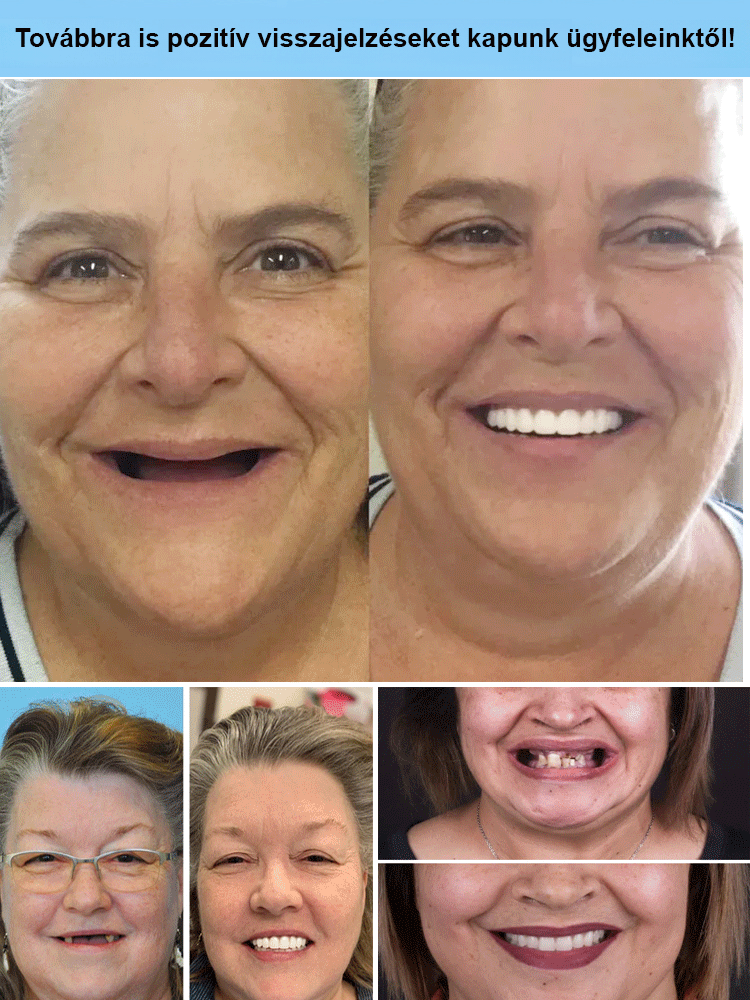 Szilikon Műfogsor Készlet